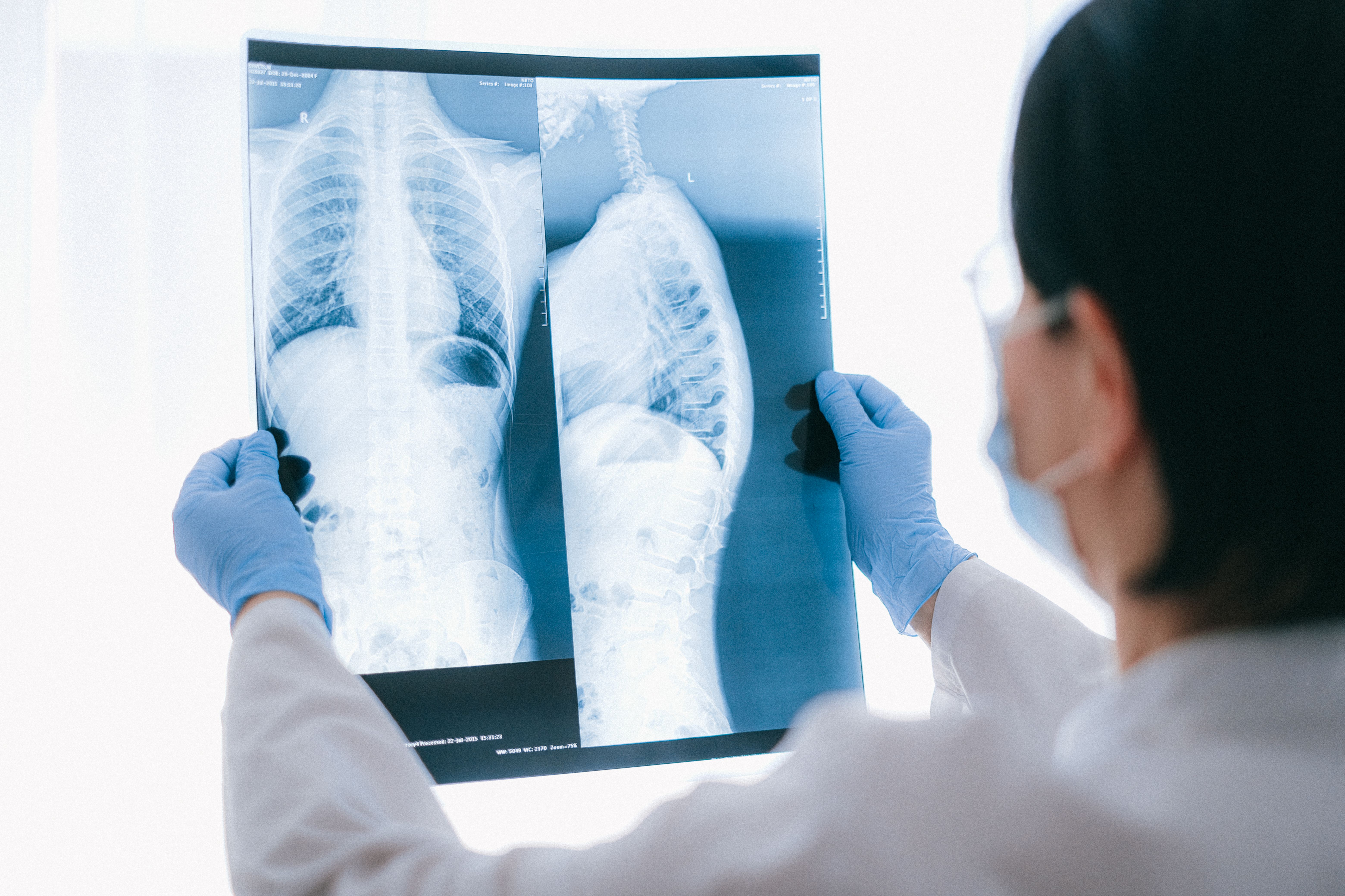 Doctor examining chest X-ray