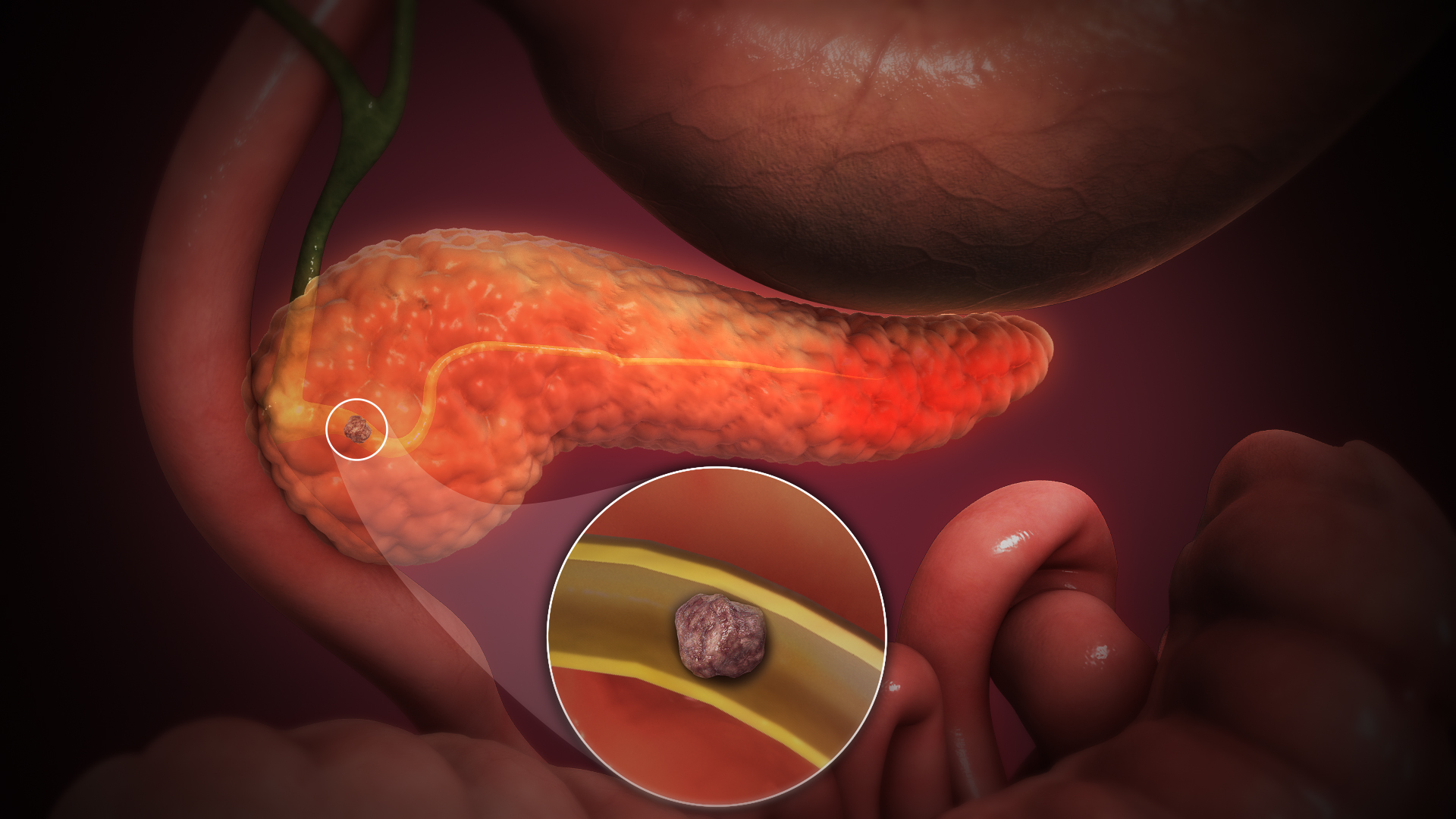 3D medical illustration of the pancreas showing acute pancreatitis with inflammation