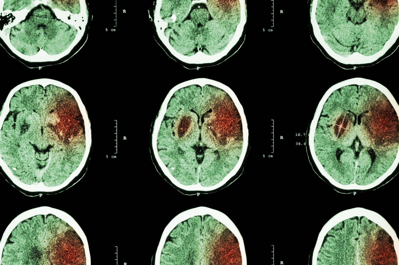 Brain CT scan showing stroke
