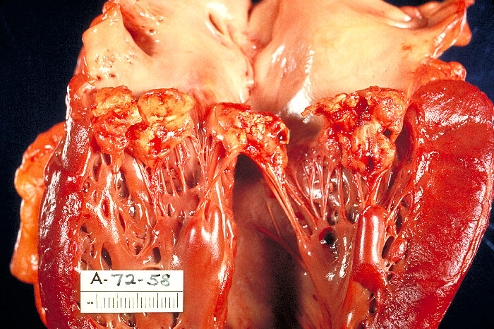 Endocarditis vegetation on heart valve