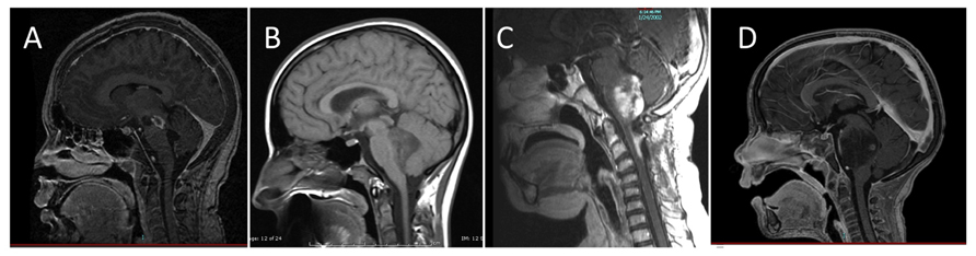 Brainstem glioma MRI classification