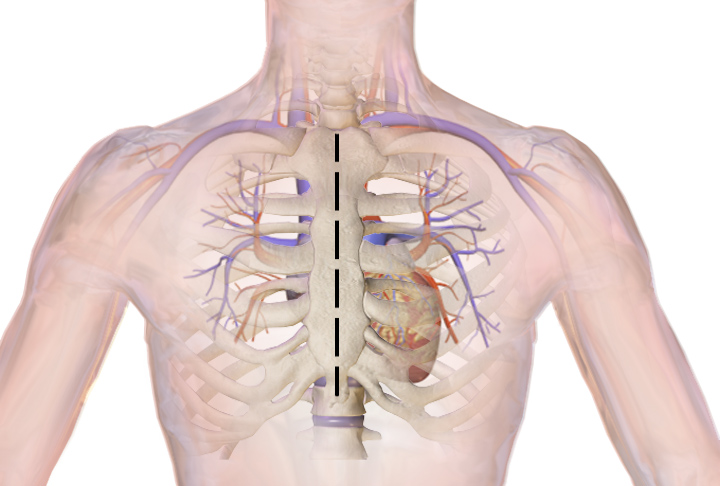 Open heart surgery incision