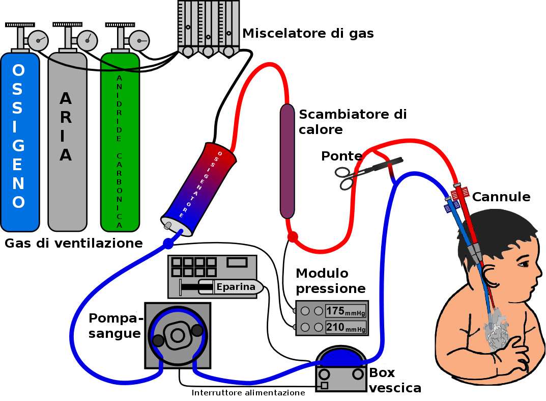 Extracorporeal perfusion system connecting gene-edited pig liver to patient circulation