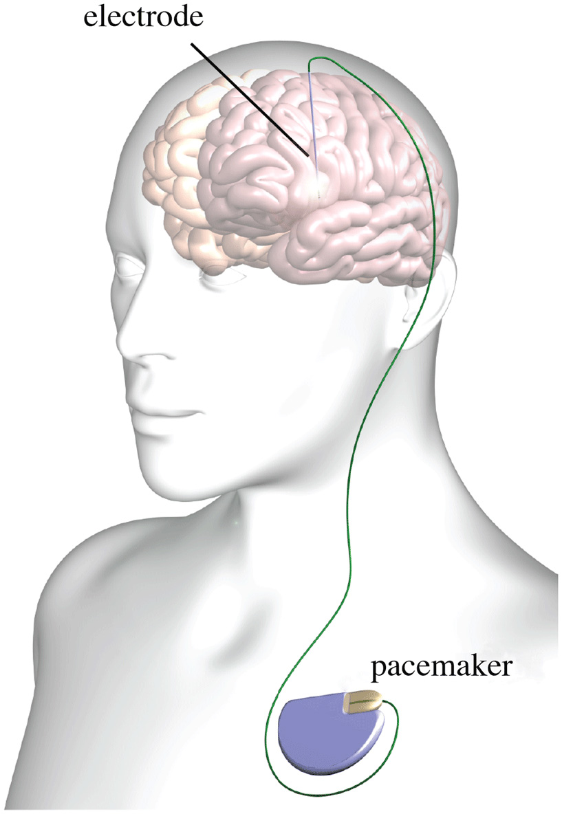 Typical deep brain stimulation setup showing implanted pulse generator and electrode leads