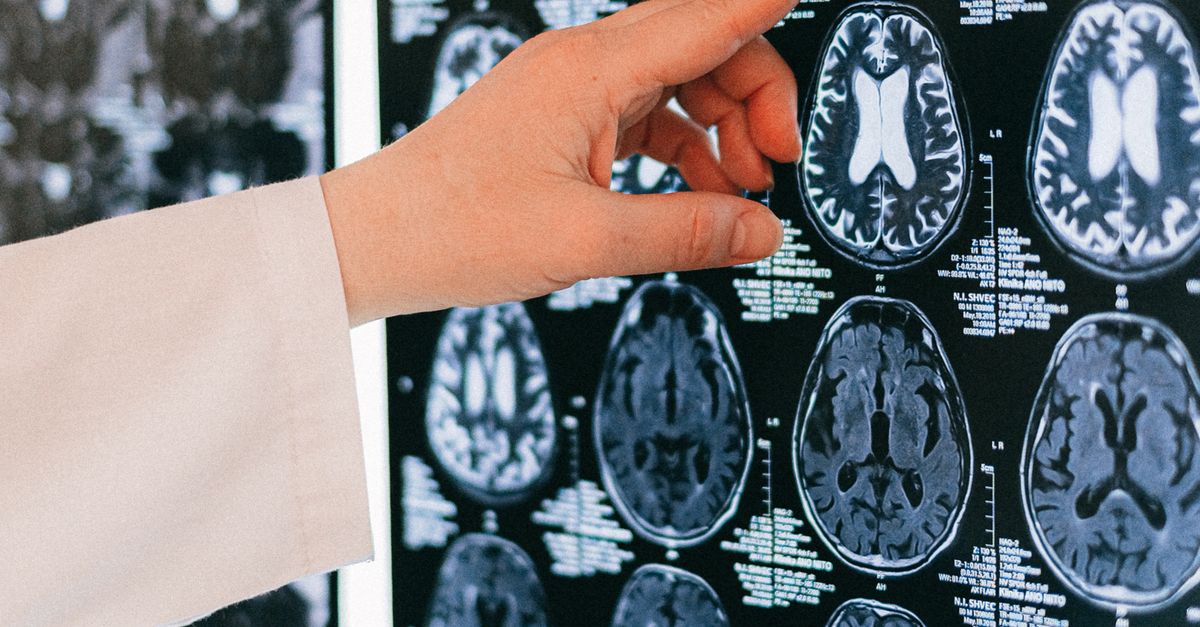 Brain MRI scan representing stroke prevention imaging