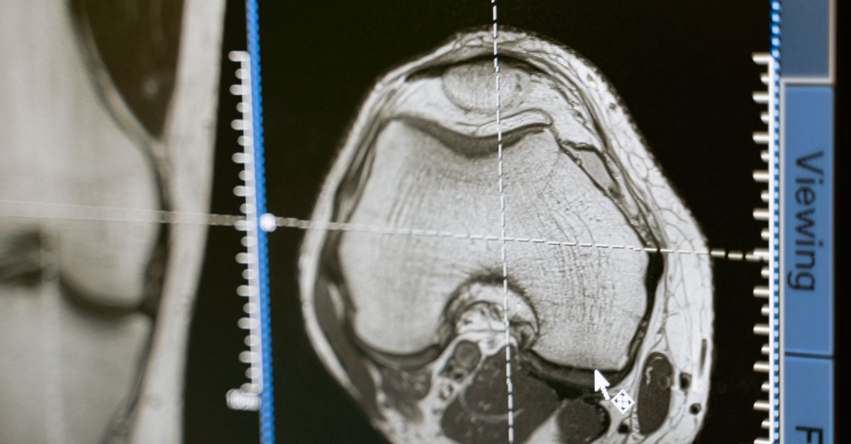 MRI scan on medical monitor representing imaging-guided therapy