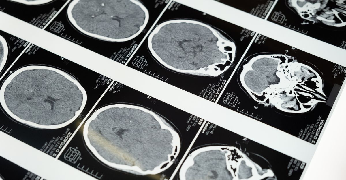 Brain MRI scans displayed on lightbox representing stroke imaging and outcome assessment