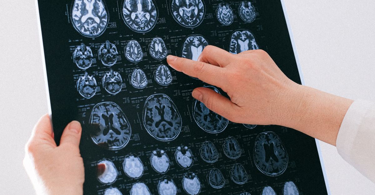 Medical professional examining brain MRI scans representing stroke clinical trial