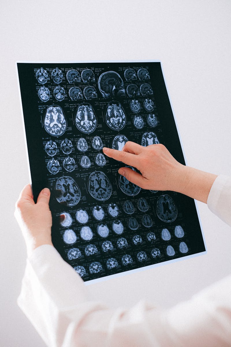 Brain MRI scan for Alzheimer's diagnosis