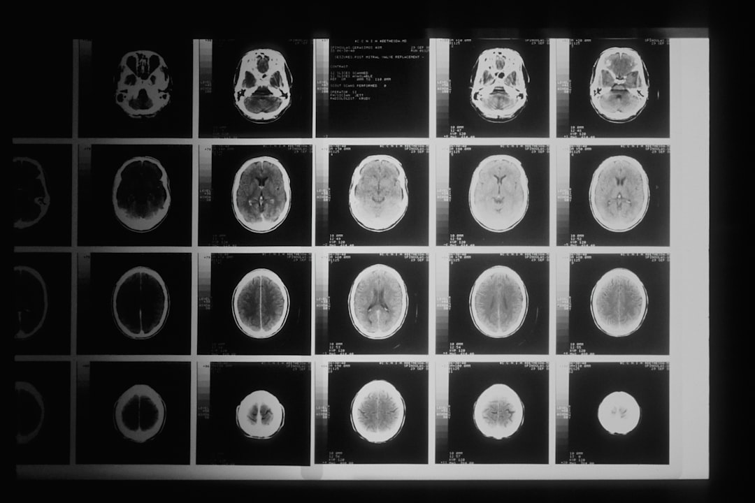 Chinese Researchers Challenge Traditional View: Lacunar Stroke May Not Stem from Large Vessel Narrowing